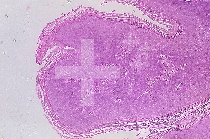 Section of a human genital wart. LM X15