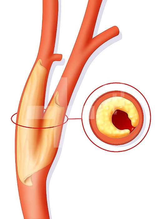 Illustration of the stenosis of the carotid. This pathology is a narrowing of the interior of the carotid artery (which ensures oxygenation of the brain), due to atheroma deposits. Stenosis of the carotid can cause a cerebral embolism (migration of a clot