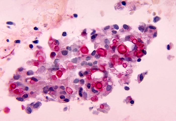 This micrograph depicts the histopathologic changes associated with cryptococcosis of the lung using Mucicarmine stain. Cryptococcosis, caused by the fungal pathogen Cryptococcus neoformans is transmitted through inhalation of airborne yeast cells and/or biospores. At risk are the immunocompromised, especially those with HIV infection.