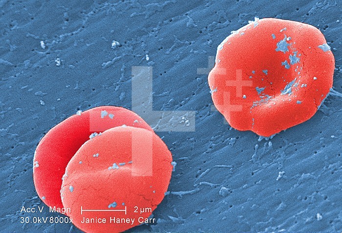 Under a high magnification of 8000X, this scanning electron micrograph (SEM) revealed some of the ultrastructural morphology displayed by red blood cells (RBCs) in a blood specimen of a 6 year old male patient that has sickle cell with hereditary persistence of fetal hemoglobin (S-HPFH). In these individuals, the presence of the persistent fetal hemoglogin reduces the severity of the consequences of the sickle cell disease, thereby, reducing the degree of cellular deformity, i.e., sickling, seen in the sickled cells.