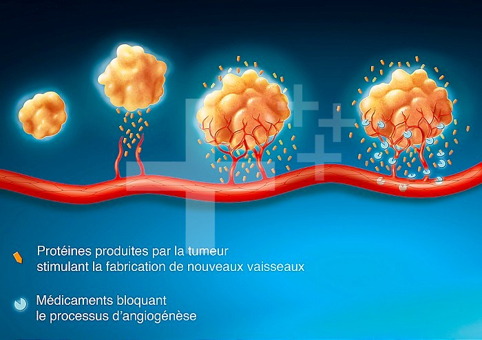 Illustration of angiogenesis. When a tumour forms, it is isolated and produces substances (VEGF) which stimulate the production of small blood vessels from neighbouring vessels. A new vascularisation surrounds the tumour and nourishes it, allowing it to g