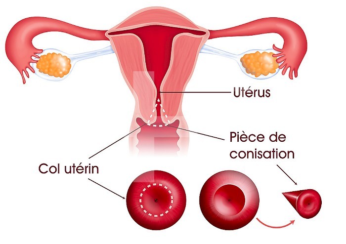 Illustration of cervical conization. It is an operation which consists of removing part of the cervix that is in the shape of a cone. It is advisable for lesions in the cervix and for treating lesions that may evolve to become cancer.