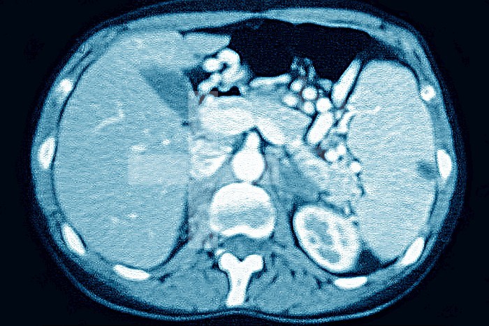 Spleen infarction seen on a radial section CT scan of the abdomen.