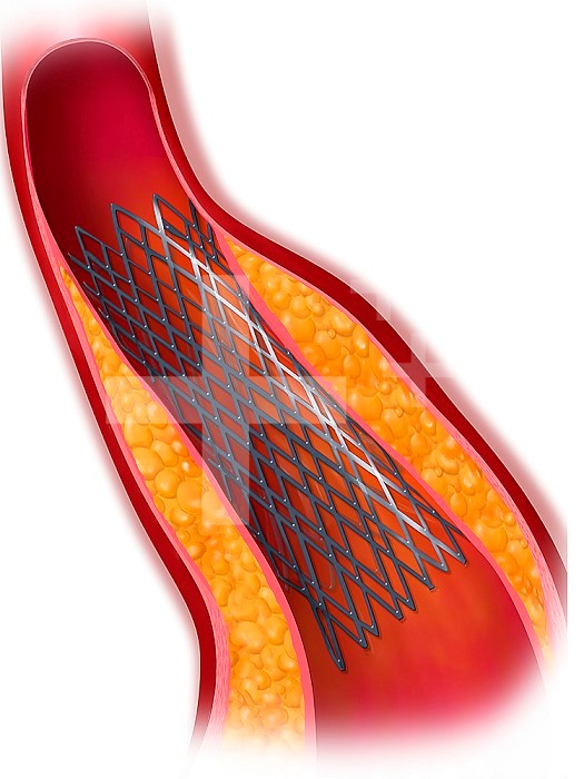 Treating stenosis with stent angioplasty.