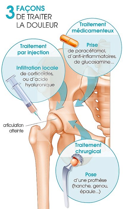Illustration of the various treatments of joint pain, shown on a hip joint: -Drug treatment using paracetamol, anti-inflammatory drugs and glucosamine. -Treatment through injection, local infiltration of corticosteroids or hyaluronic acid. -Surgical treat