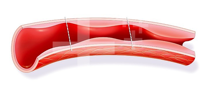 Illustration of an artery. On the left, the lining is normal, with normal arterial pressure. In the centre, the lining is thicker and diminishes the internal light of the artery which leads to prehypertension. On the right, the lining is very thick and co