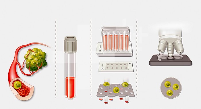 Illustration of screening for cancer with a blood test. In the case of a cancerous tumour, tumour cells pass into the bloodstream. In a blood test and analysis which filters the blood and lets small red blood corpuscles through while retaining the larger 