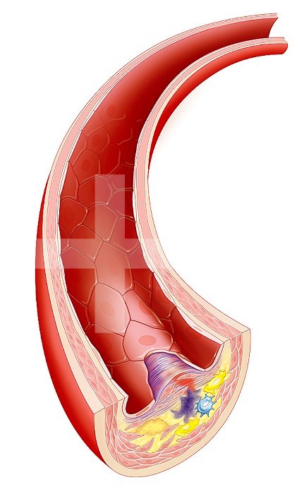 Illustration of a rupture in the atheromatous plaque. The plaque has built up and become unstable which has caused part of the plaque to detach itself, potentially leading to a myocaridal infarction, a CVA, or an obliterating arteritis of the lower limbs 