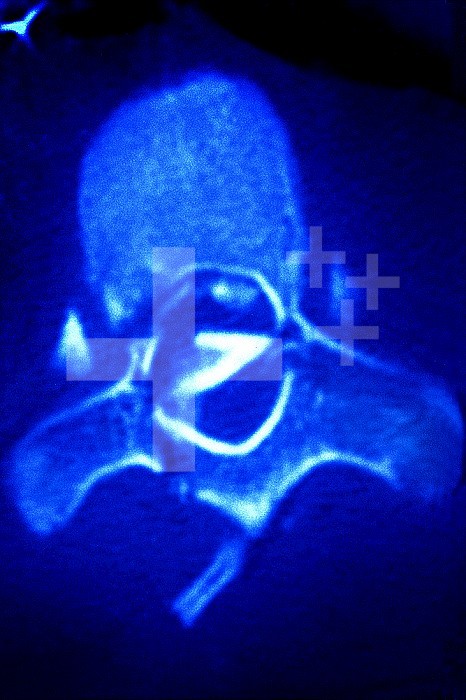 Thoracic vertebra fracture, seen on a cross-section vertebral scan.