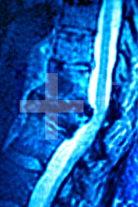 Herniated disk at the ninth and tenth thoracic vertebra, seen on a sagittal section MRI scan.