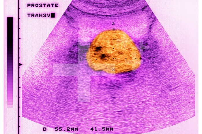Prostatic adenocarcinoma seen in a transverse section ultrasound scan.