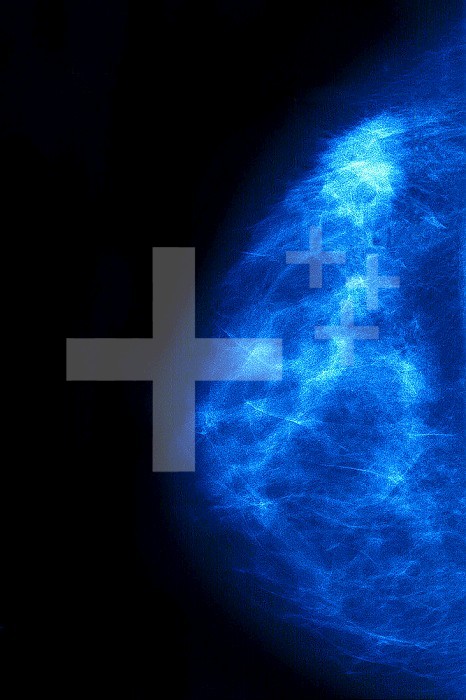 Breast cancer (adenocarcinoma), seen in a mammogram.