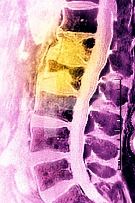 Osteoporosis with compression of L1-L2 vertebrae, seen on a sagittal plane MRI scan.