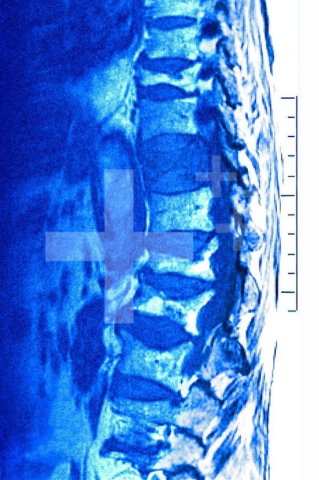 Osteoporosis with compression of the dorsal and lumbar vertebrae, seen on a sagittal plane MRI scan.