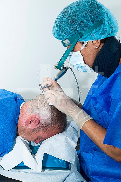 Reportage in the Mozart plastic surgery clinic in Nice, France. FUE (Follicular Unit Extraction) hair transplant on a patient who has already undergone two strip harvesting sessions which have left scars. FUE will avoid this. FUE involves harvesting individual follicular units using a hollow needle that is 0.9-1.2mm in diameter, and reimplanting them in the bald patch. Harvesting.