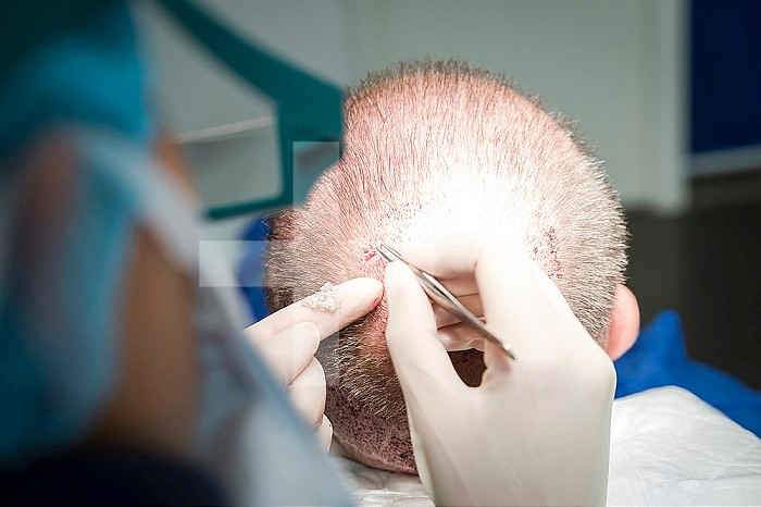 Reportage in the Mozart plastic surgery clinic in Nice, France. FUE (Follicular Unit Extraction) hair transplant on a patient who has already undergone two strip harvesting sessions which have left scars. FUE will avoid this. FUE involves harvesting individual follicular units using a hollow needle that is 0.9-1.2mm in diameter, and reimplanting them in the bald patch. Reimplanting the grafts which can be seen on the operator?s finger.