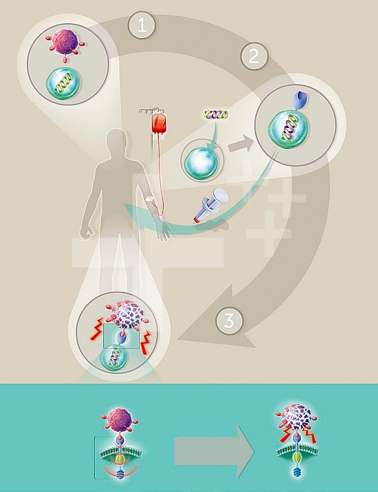 Illustration of the principle of CAR-T cell immunotherapy consisting of modifying some of the patient?s immune cells, T lymphocytes, so that they directly and specifically recognize the tumor cells and attack them. T lymphocytes are removed and genetically modified (CAR-T cells) so that they will specifically recognize certain diseased cells. CAR-T cells bond with the cancer cells which triggers various activities (the production of cytokines, expansion of lymphocytes etc.) contributing to the destruction of the cancer cells.