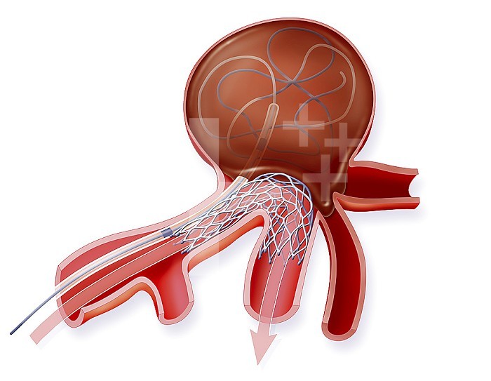 Illustration of aneurysm treatment using a stent. A stent is placed before the entry to the aneurysm and a catheter is inserted up to the aneurysm where the coils are deposited, which enable blood coagulation in the aneurysm but not beyond.