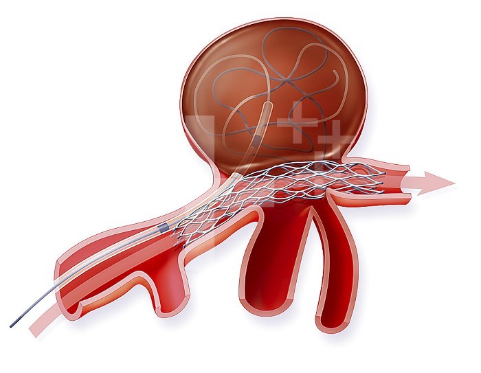 Illustration of aneurysm treatment using a stent. A stent is placed before the entry to the aneurysm and a catheter is inserted up to the aneurysm where the coils are deposited, which enable blood coagulation in the aneurysm but not beyond.