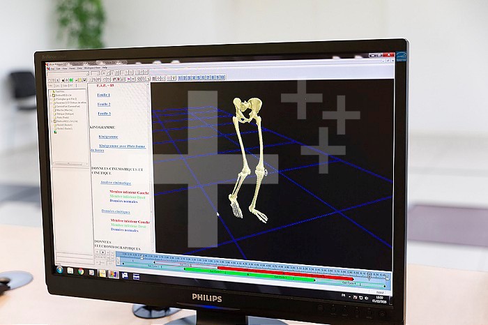 Reportage on the Rossetti health centre in Nice, France. This rehabilitation centre is a hub of excellence with cutting-edge technology. Seen here, a quantified motion analysis test carried out in the Clinical Motion Analysis Unit, a technical platform enabling a better understanding of walking anomalies. Kinegram, on the screen, of a 15-year old patient suffering from cerebal palsy who is physically retarded and has orthopedic disorders.