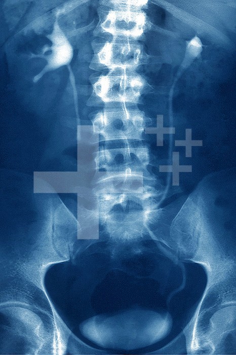 Renal colic of the right kidney, blockage in the urethra by a nephrolith with upstream renal dilation. Frontal abdominal x-ray.