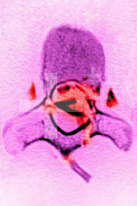 Fracture of a dorsal vertebra, with damage to the spinal cord with a bony fragment in the neuroforamen. Cross-section scanner.