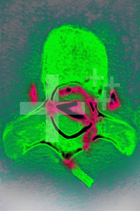 Fracture of a dorsal vertebra, with damage to the spinal cord with a bony fragment in the neuroforamen. Cross-section scanner.