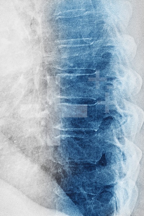 Vertebral osteoarthritis with osteophytes (bone spurs) seen on a saggital plane x-ray of the thoracic vertebrae.