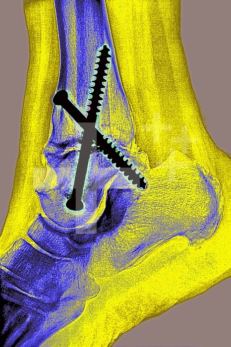Arthrodesis of the ankle involving the tibia, the talus and the heel bone. Saggital plane x-ray of the right ankle.