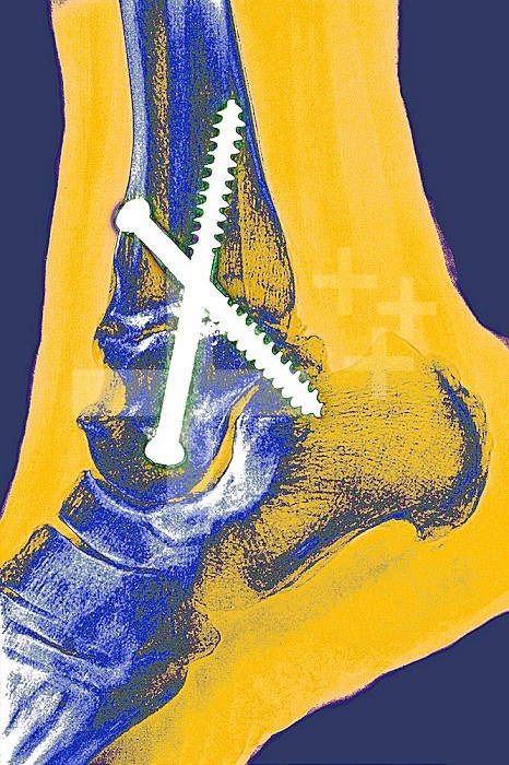 Arthrodesis of the ankle involving the tibia, the talus and the heel bone. Saggital plane x-ray of the right ankle.
